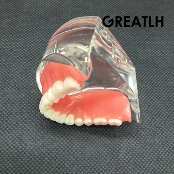 Dental Sobredentadura Interior Mandibular, Dentes Inferiores Modelo Mandibular Com Restauração De Implantes De Dentes Dental De Ensino De Estudo